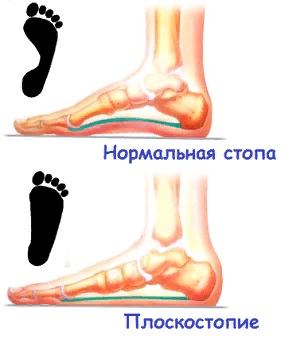 Плоскостопие.